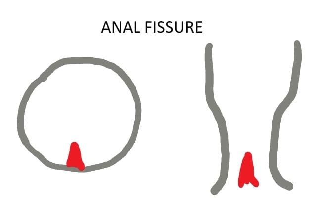 Anal Fissure
