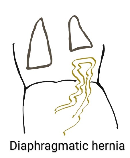 Diaphragmatic Hernia