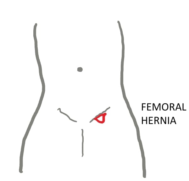 Diagram showing Femoral Hernia