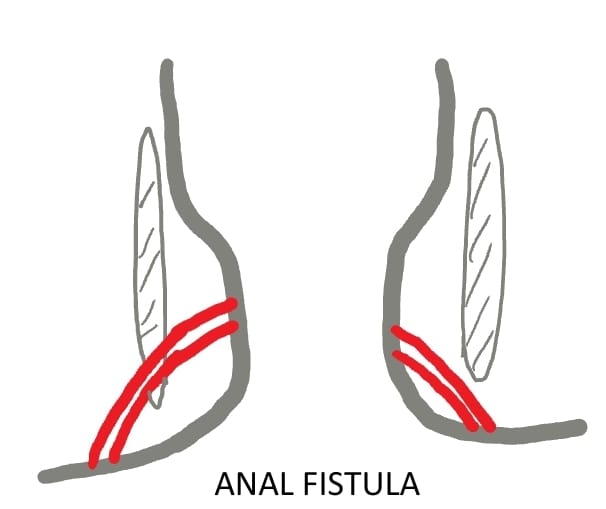 FistulaIn Ano