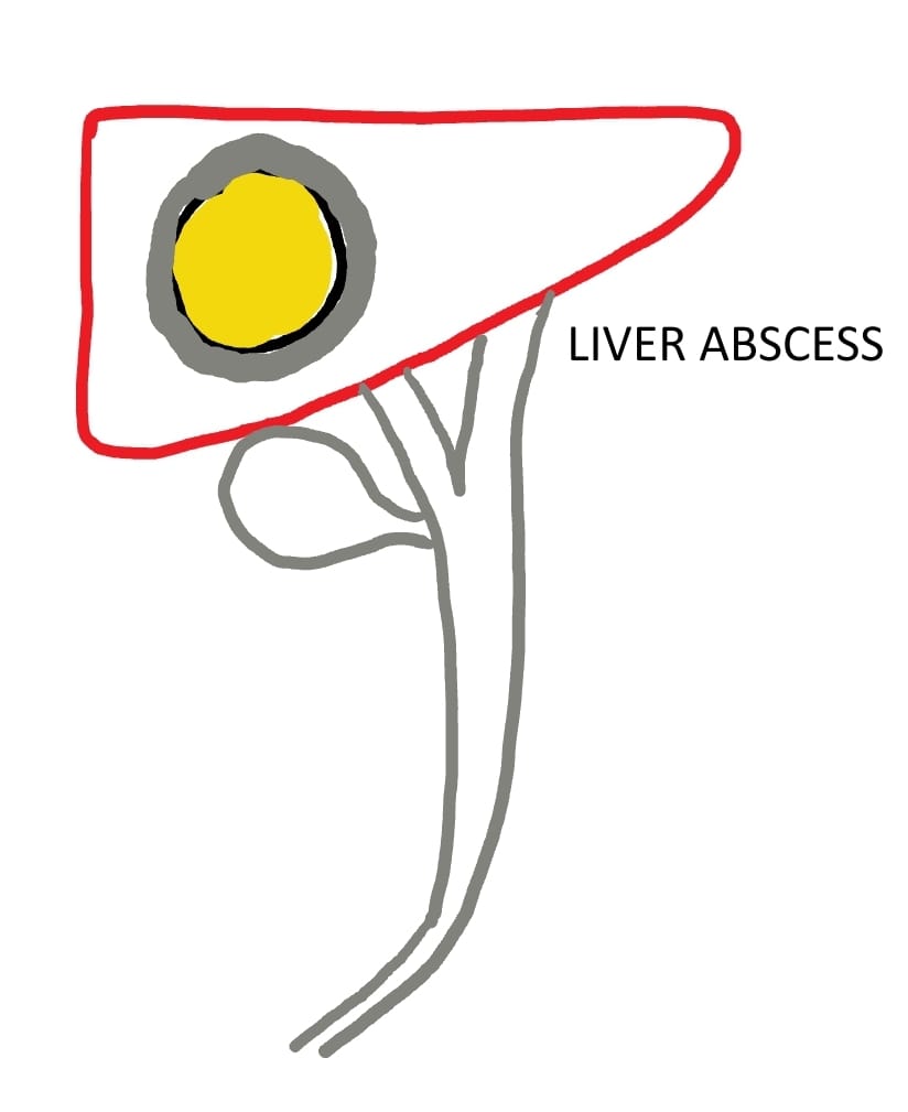 Liver Abscess