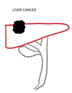 Liver Cancer