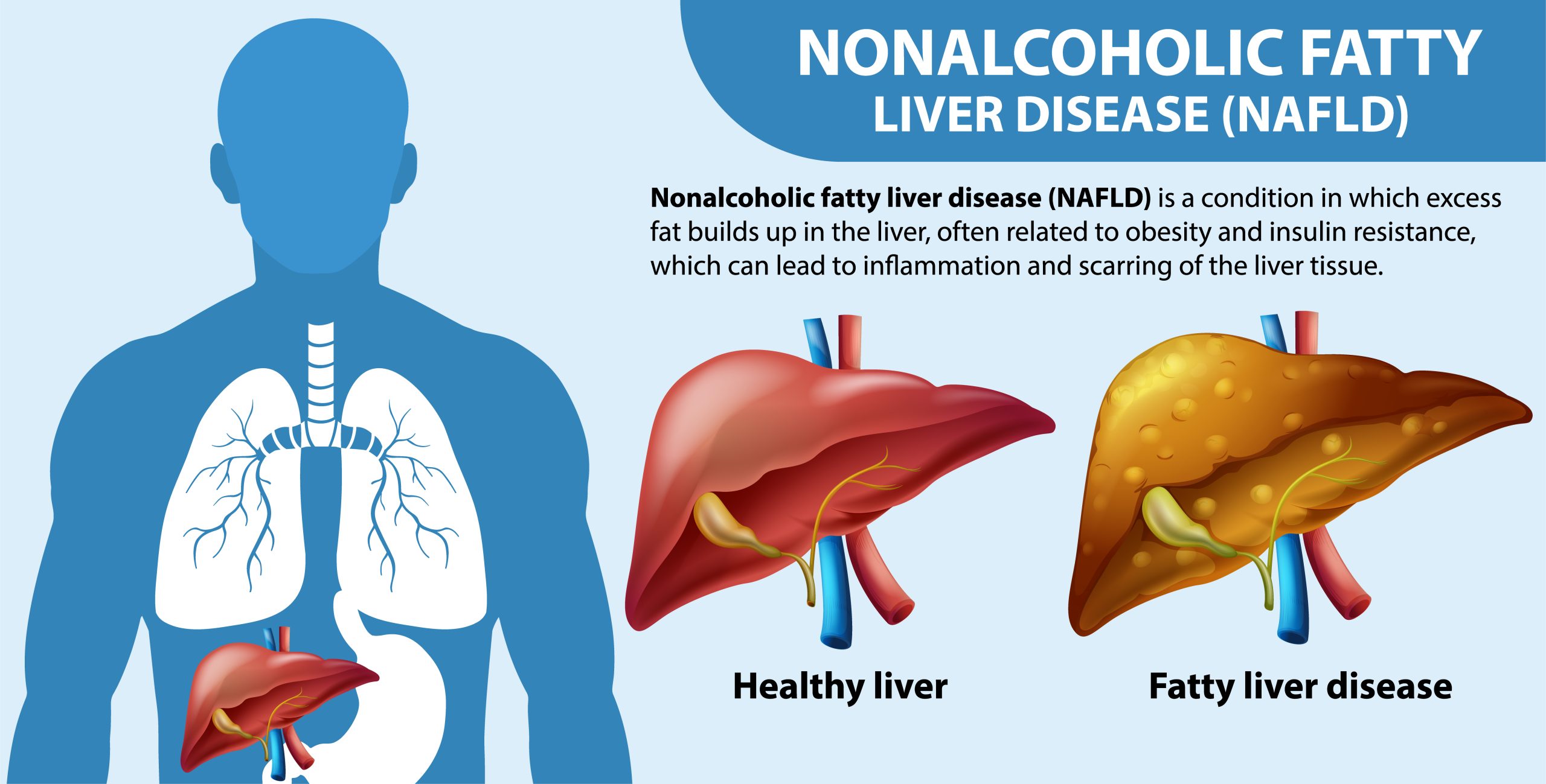 Infographic about Non-alcoholic liver disease