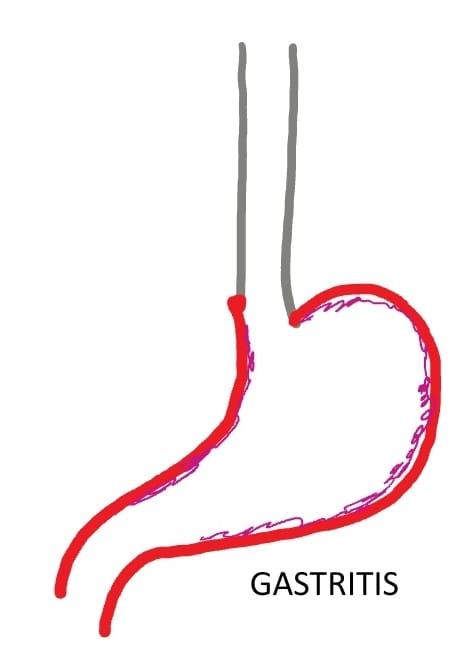 Diagram showing Gastritis