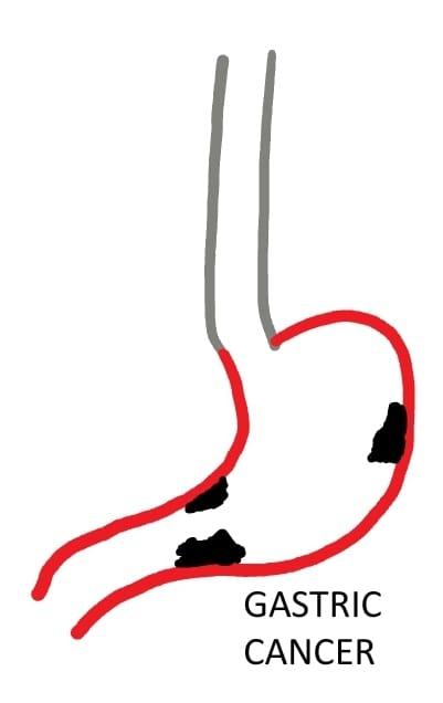 Diagram showing Stomach Cancer