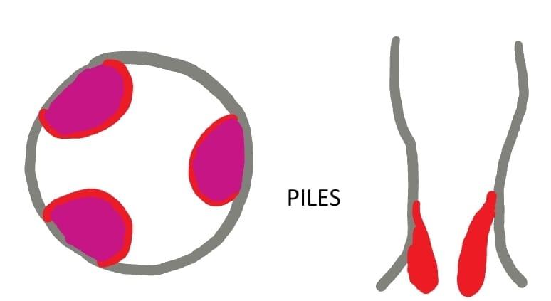Piles Treatment in Hyderabad