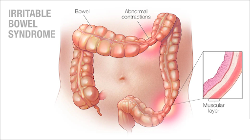 IBS