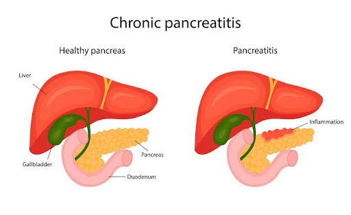Chronic Pancreatitis image