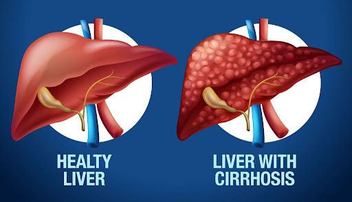 Cirrhosis of the Liver image