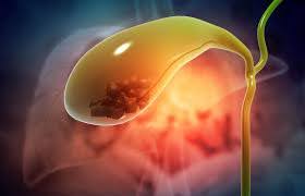 Gallstones and Gallbladder Cancer