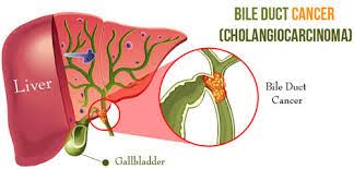 Cholangiocarcinoma