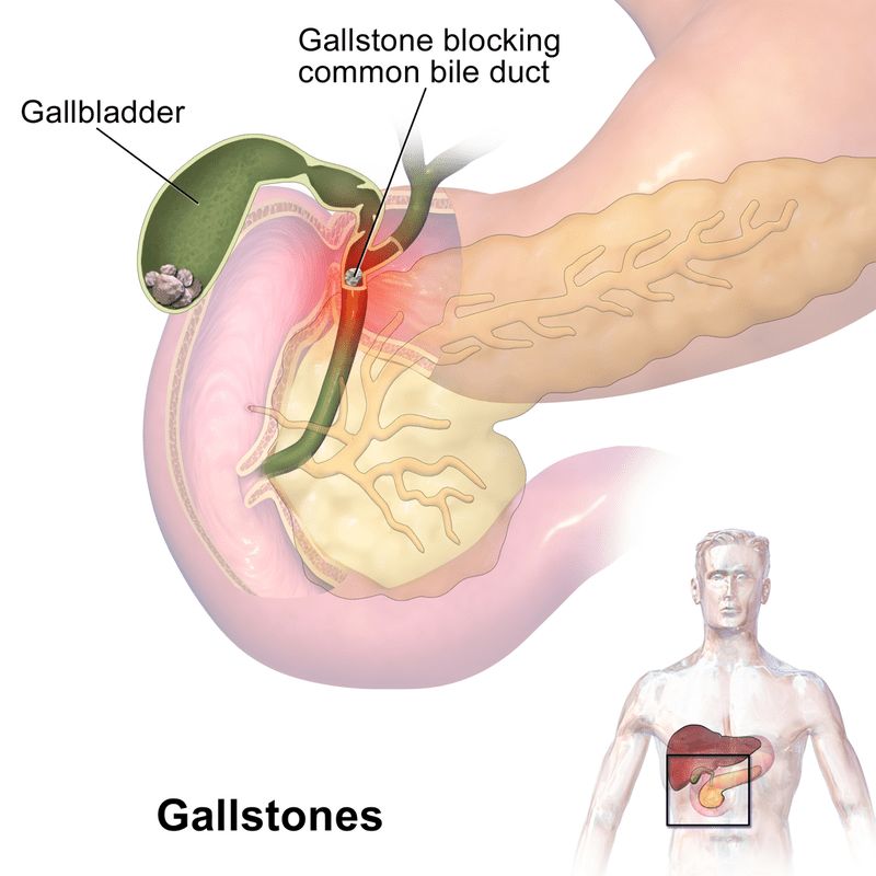 cholelithiasis image