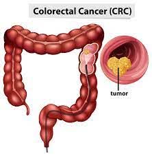 a diagram of a colon cancer