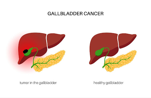 a diagram of a liver and a healthy gallbladder