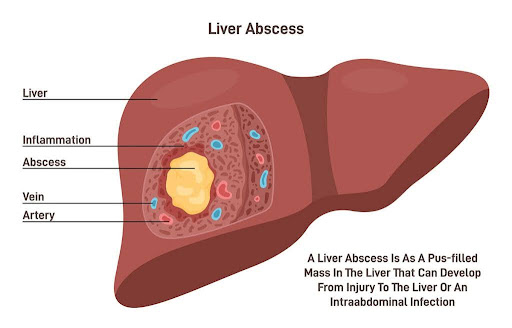 liver abscess image