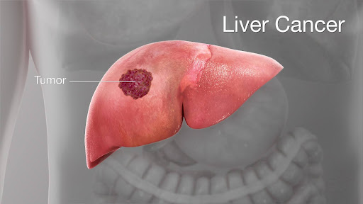 liver cancer image