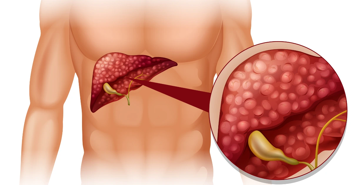 Liver Cirrhosis