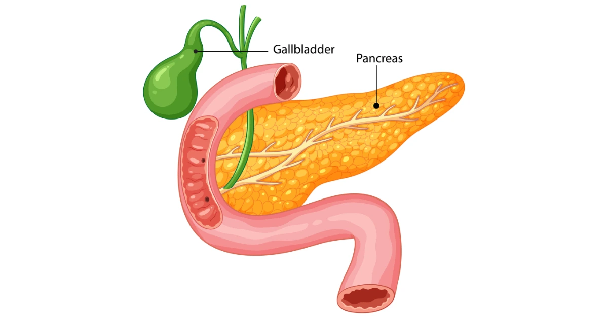 Acute Pancreatitis