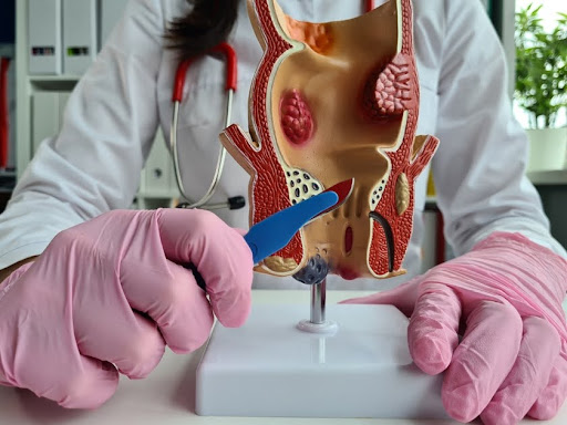 Laser Treatment For Piles in Hyderabad
