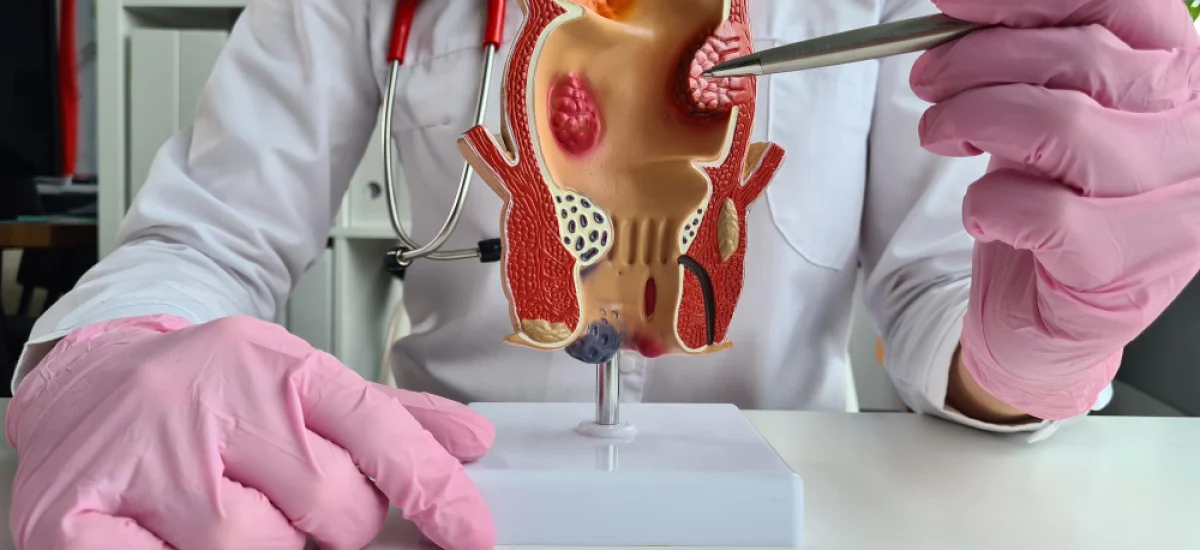 Anal Fistula treatment in Hyderabad Anal Fistula treatment in Hyderabad