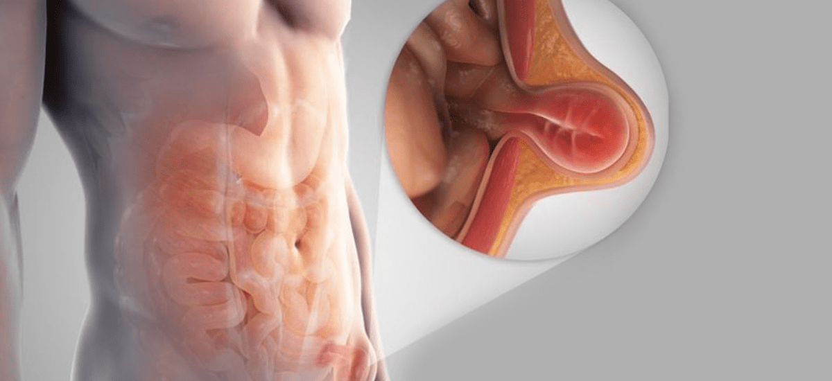 Laparoscopic Inguinal Hernia Render of Laparoscopic Inguinal Hernia
