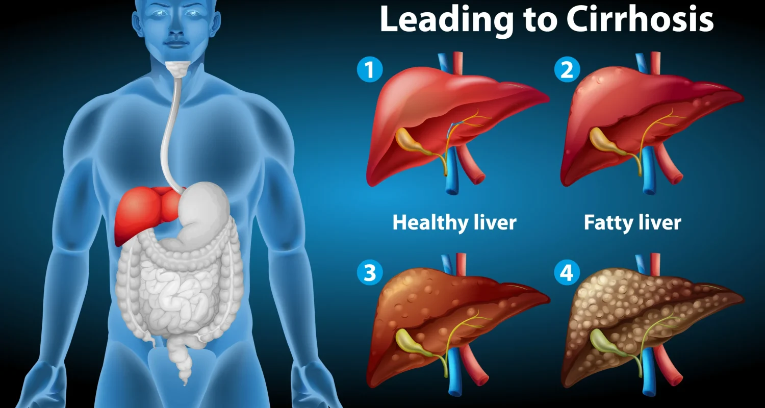 Factors Influencing the Progression of Cirrhosis Factors Influencing the Progression of Cirrhosis