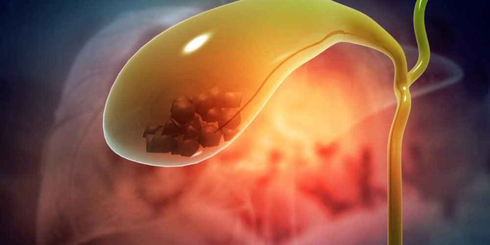 Render of Gallbladder stones